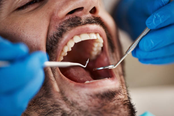 Best Emergency Dentist for Lost Fillings or Crowns in USA